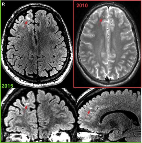 gliosis in humans.